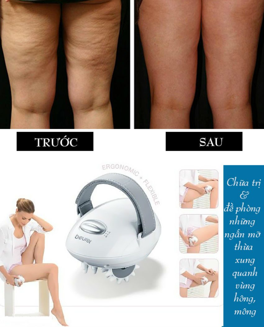 Máy massage cầm tay trị liệu bệnh Cellulite Beurer CM50 - Hàng chính hãng